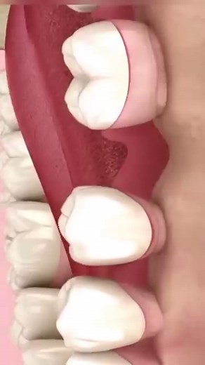 Consecuencias de la pérdida de un diente ➡️ Las ausencia de piezas hace que los dientes adyacentes tiendan a moverse para ocupar el hueco que ha quedado libre ➡️ De manera que pueden quedar contactos interdentales irregulares que favorecen la retención de alimentos y dificultan la higiene dental ➡️ Lo cual aumenta el riesgo de aparición de caries, sarro, fracturas, sangrado, inflamación de encías y periodontitis ➡️ Problemas de masticación y desgaste de las piezas dentales ➡️ Y pérdida de hueso 