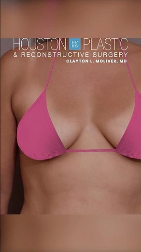 Breast augmentation mastopexy using saline implants #breastaugmentationsurgery #plasticsurgeon