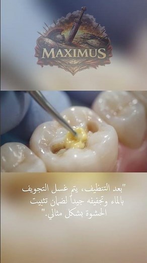 أسرار ترصيص الضرس بدون ألم 😮🦷 | كيف يتم حشو الأسنان خطوة بخطوة!