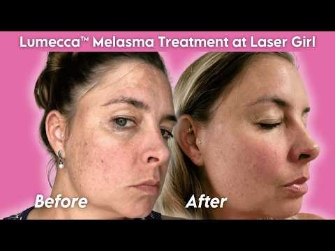 Melasma Before & After with Lumecca™ IPL by InMode