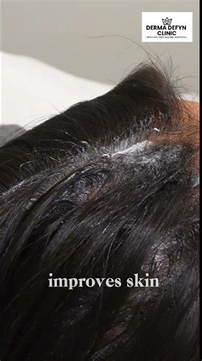 PRP Treatment at Derma Defyn #skincare #beauty #trendingreels