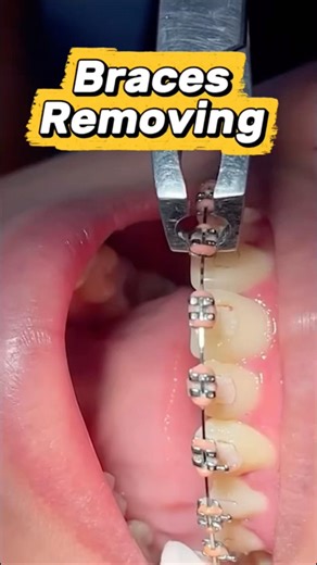 Is Braces Removing PAINLESS?! 🤯 #braces #orthodontist #bracesoff