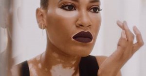CoverGirl’s Newest Model Has Vitiligo — & Just Made Beauty History
