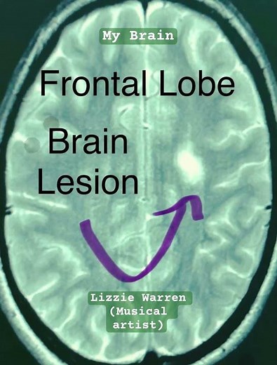 Neuroscience: Frontal Lobe Lesion Example (Educational Video)