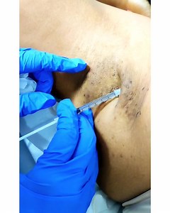 Did you know that Botox is not only a cosmetic fix? Botox shots...