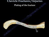 Clavicle Fracture - Video Lecture • Video • MEDtube.net