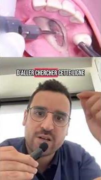 Extraction of an INCLUDED canine: a precise intervention