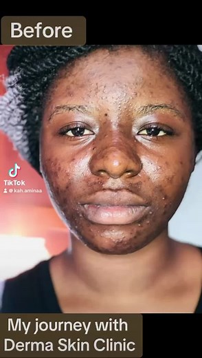 Get Clear Skin at Derma Skin Clinic in Kampala, Uganda