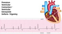 Premature Ventricular Contraction PVC - Uniform - Trigeminy -...