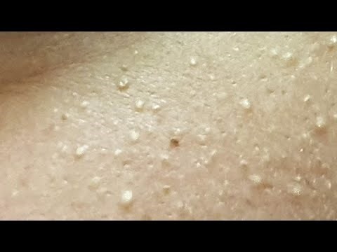 Multiple MILIA around the EYES - Left side- #1