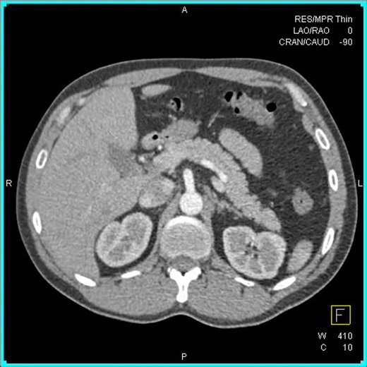 closed loop obstruction 1 | CTisus
