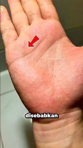 Itchy Palms