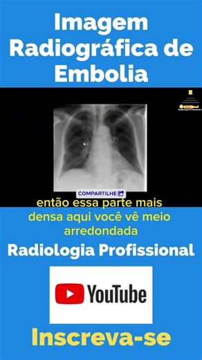Radiographic Image of Embolism