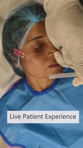 Learn Mono Threads with Hands-on Training on a Live Patient | #youtubeshorts #viralvideo #skincare