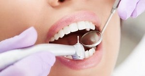 Empaste dental: la obturación como solución para la caries
