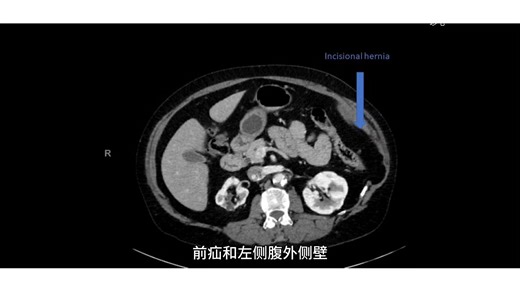机器人辅助经腹膜外疝修补术（eTEP）联合单侧经腹膜外疝修补术（eTAR）用于腹壁疝修补，手术技术