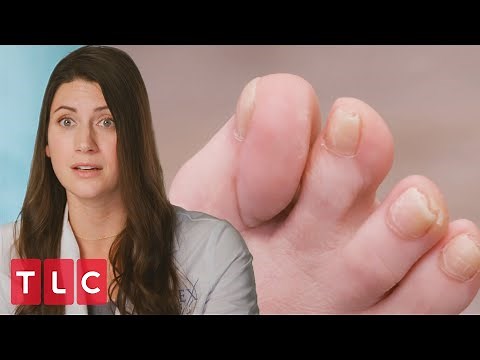 Patient's Toe Is Turned Completely Sideways | My Feet Are Killing Me