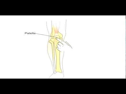 La perfusion intra-osseuse - La technique