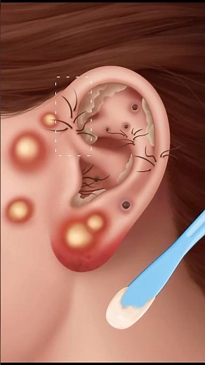 Remove Ear pimple blackhead animation video#asmrvideo #satisfying #relaxing #pimplepopping