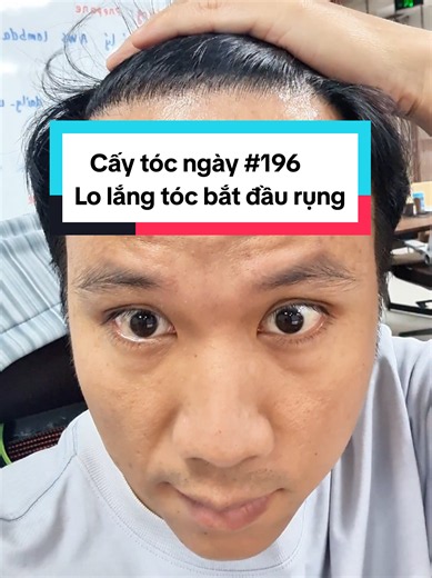 Cấy tóc ngày 196: lo lắng tóc bắt đầu rụng - nên làm gì?