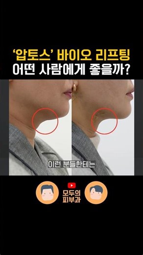 Aptos thread lifting is effective for 'these' people.