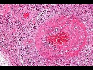 FIBRINOID NECROSIS? : What is Fibrinoid Necrosis? - What causes Fibrinoid Necrosis? Histology