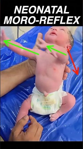 The Neonatal Moro Reflex #pediatrics #medical #education #neuroscience #baby