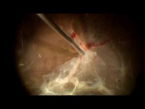 23 g Vitrectomy in Tractional Retinal detachment.