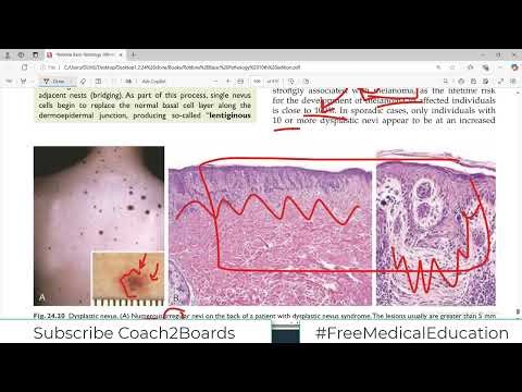 Chp#24 Robbins Patho | Skin Patho | Dysplastic Nevi | Dr Asif Lectures