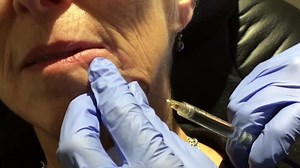 Juvederm for marionette lines