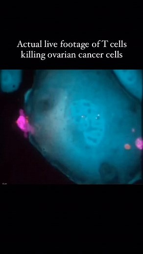 World of Biology on Instagram: "Witness the actual live footage of T cells killing ovarian cancer cells under spinning disc confocal microscope.🔬 Killer T cells induce apoptosis in cancer cells through the release of cytotoxic substances like perforin and granzymes, triggering a cascade of events leading to cell death.☠️ 1. Killer T cells first recognize cancer cells.👀 2. They release perforin to create pores in the cancer cell membrane.✨ 3. Granzymes enter through these pores and activate cas