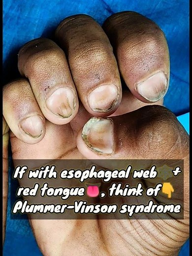 Iron Deficiency Anemia