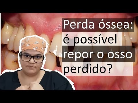 How to recover bone lost in bone loss (periodontitis)? | Dr. Bianca Rosa