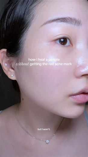 my morning routine to calm a pimple without getting acne marks
