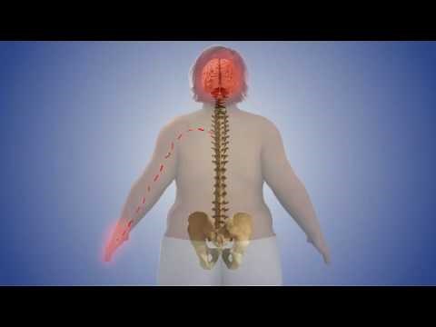 Spinal Cord Stimulator Implant & CRPS Animation Procedure