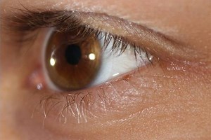 What Are Prednisolone Eye Drops Used For?