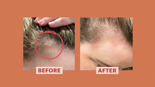 My Scalp Psoriasis Came Out of Nowhere — Here's How I Finally Got It Under Control