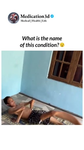 Medical | Health | Life on Instagram: "Have you ever seen something like this before? Human bodies can take on an incredible range of shapes and proportions, and sometimes that's due to rare genetic or developmental conditions that affect growth, connective tissue, or muscle structure. While I'm not drawing any conclusions about this specific video, it's just a reminder of just how diverse the human body can be. Some conditions can influence height, limb length, or how the body builds tissue, cr