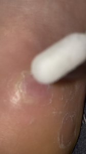 Anyone have any luck using the at home freezing kits?