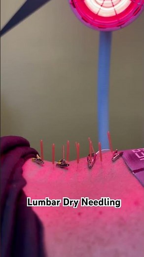 Lumbar Dry Needling | Pain Relief