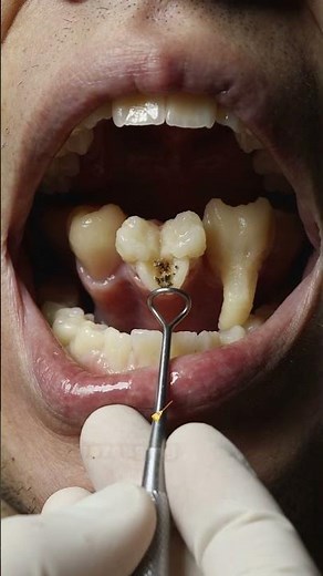 How a Tooth is Treated: From Cavity to Healthy Tooth | Dental Procedure Explained