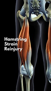 Hamstring Strain Reinjury Nearly one third of hamstring strain injuries recur within the first year following rehabilitation and a return to athletic activity. Research suggests several factors contribute to the high rate of reinjury: Persistent weakness in the injured muscle Reduced extensibility of the musculotendon unit due to scar tissue Compensatory changes in the biomechanics of movement due to the original injury Lack of strength and control of the lumbopelvic muscles Quadriceps tightness