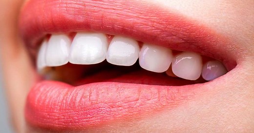 Clareamento dental: 5 mitos e verdades sobre o procedimento