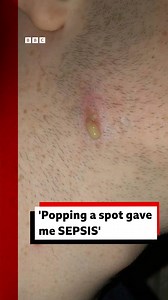 A man who nearly died from sepsis after popping a spot on his neck is warning others about the dangers of the potentially deadly condition Geraint Mullins, 24, from Newport, was at home watching TV when he noticed a pimple on his neck and popped it In less than a day the spot had turned into an abscess and he soon developed sepsis, requiring emergency hospital treatment and two operations Mr Mullins, who believes he is fortunate to be alive, wants others to be aware of the signs and symptoms of 