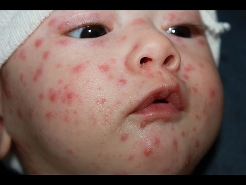 Ospa wietrzna: objawy, leczenie, szczepienie