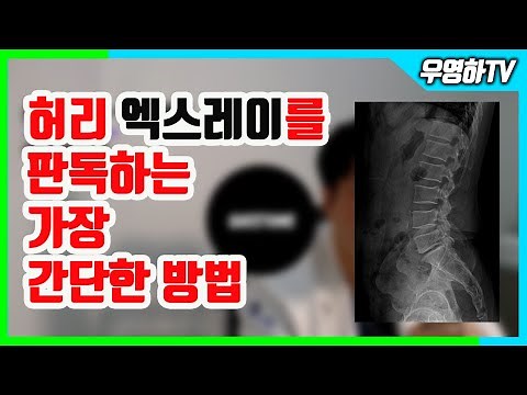 [ 부산신경외과추천 , 부산통증의학과추천 ] 허리 사진, 요추 엑스레이 보는 가장 간단한 방법 (부산큰병원 우영하)