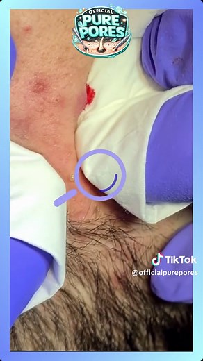 Extreme Blackhead Removal and Skincare ASMR Compilation