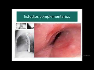 Enfoque del estridor en la edad pediátrica: ¿Qué hay además de la laringomalacia?