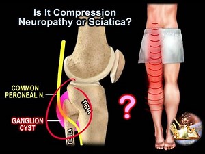Is It Compression Neuropathy or Sciatica - Everything You Need To Know - Dr. Nabil Ebraheim • Video • MEDtube.net