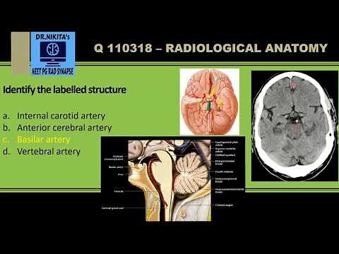 Circle of Willis- CT Brain
